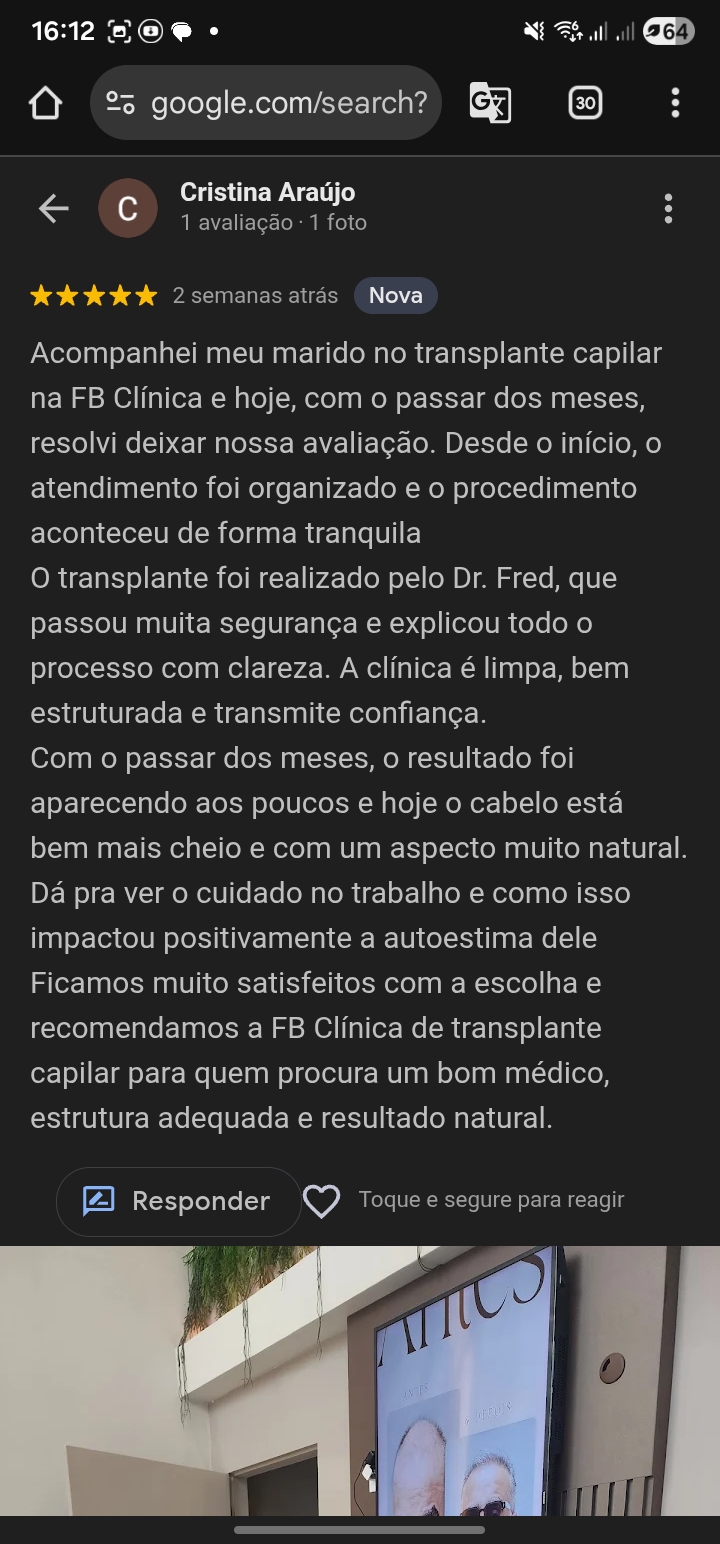 transplante capilar em Cabo Frio