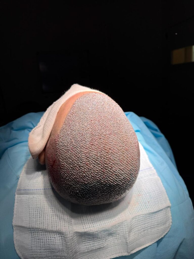 Transplante capilar em Cabo Frio